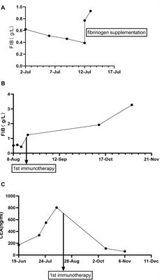 Sintilimab, a PD-1 Inhibitor, Completely Reversed Rarely Refractory <mark class="highlighted">Hypofibrinogenemia</mark> in a Gastric Cancer Patient: A Case Report and Review of the Literature